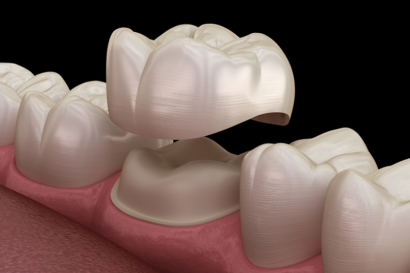 Dental Crowns in Porter