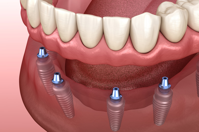 Dental Crowns in Porter